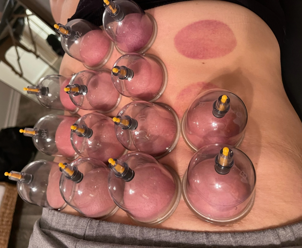 Cupping Releases Tension On Back
