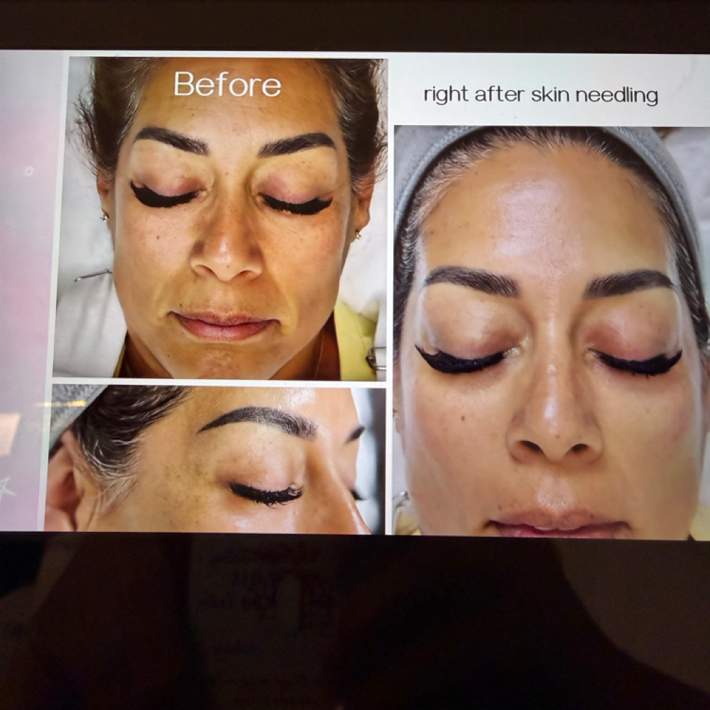 Skin Rejuvenation at Excellent Nails By Sandy in California, CA