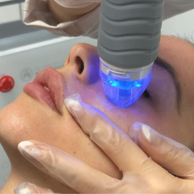 RF Microneedling at Ush Beauty & Wellness Lounge in North Potomac, MD
