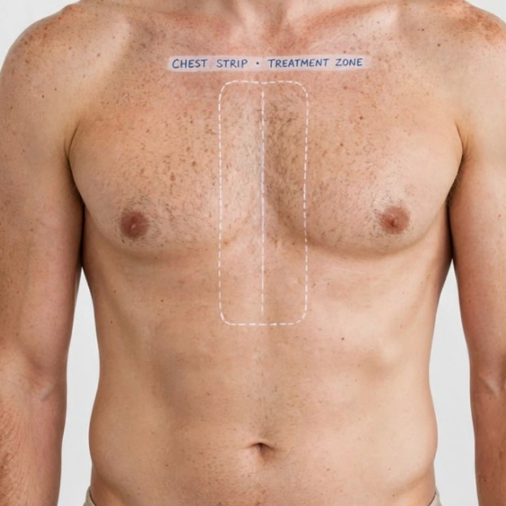 Chest Strip I 6 Sessions at EverBeauty Laser & Aesthetics in Argyle, TX