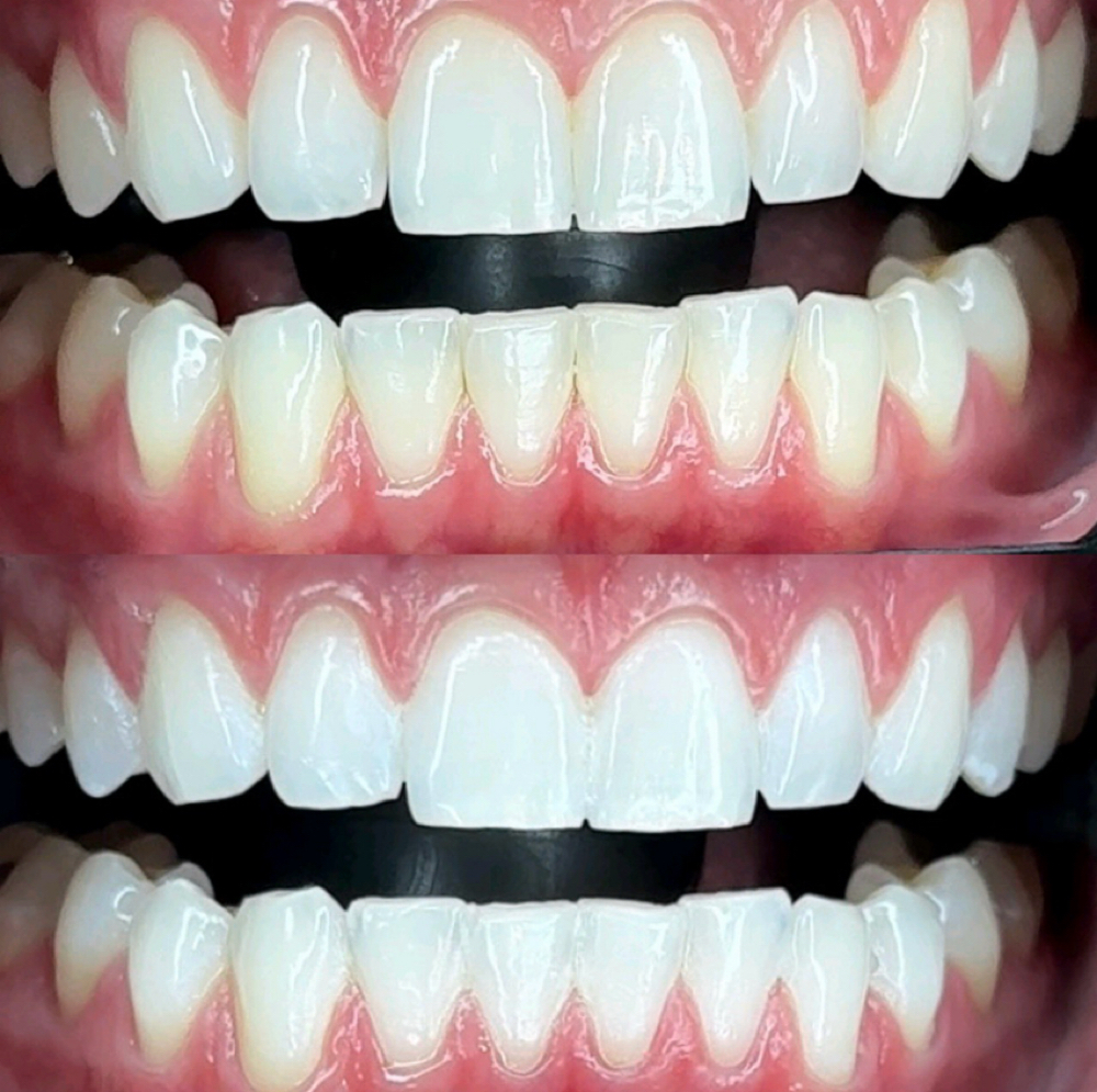 First time teeth whitening at Beauty by MSG in Des Plaines, IL
