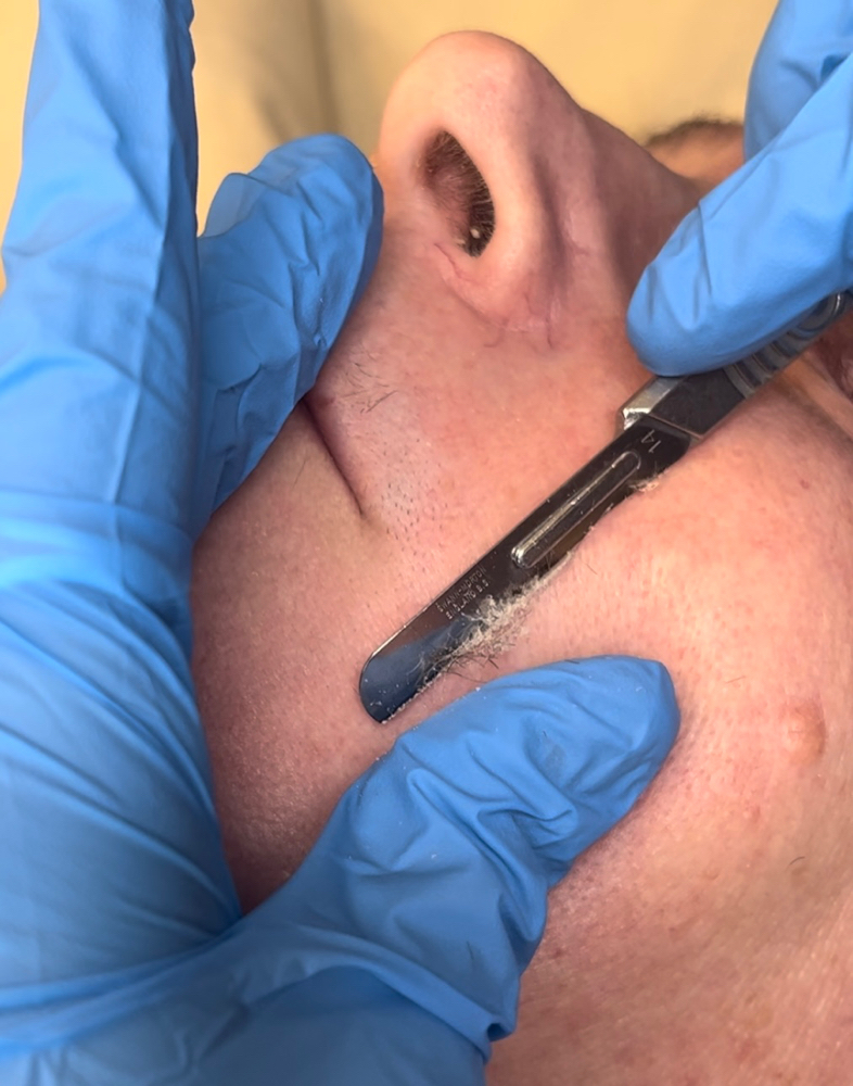 Dermaplane