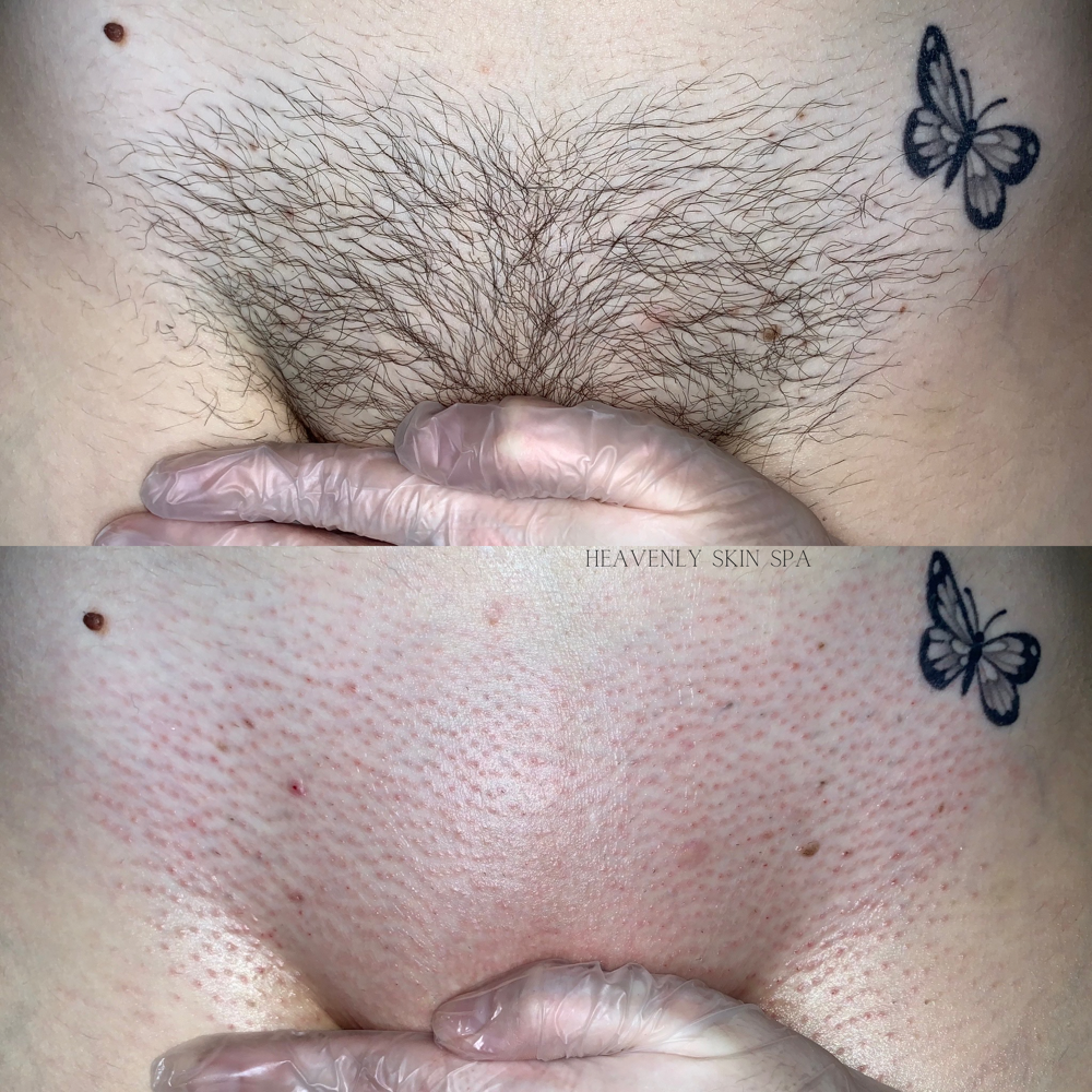 Brazilian + Butt Cheeks