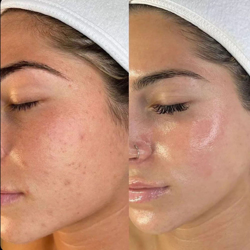 Acne Dissolving Facial at Espy Esthetics in Midland, TX