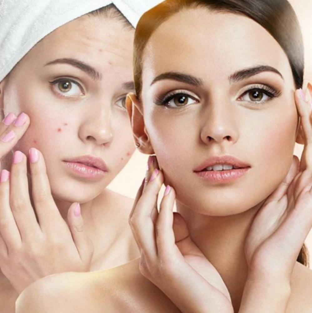 Anti- Acne Facial
