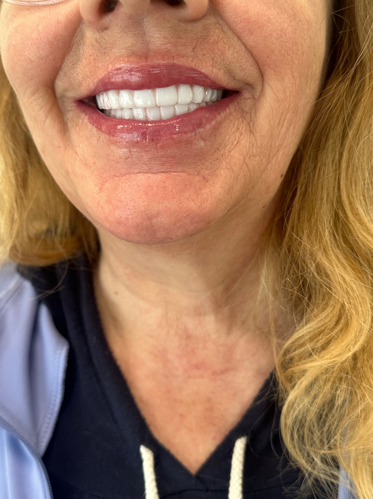 Semi-Permanent Lip Blush