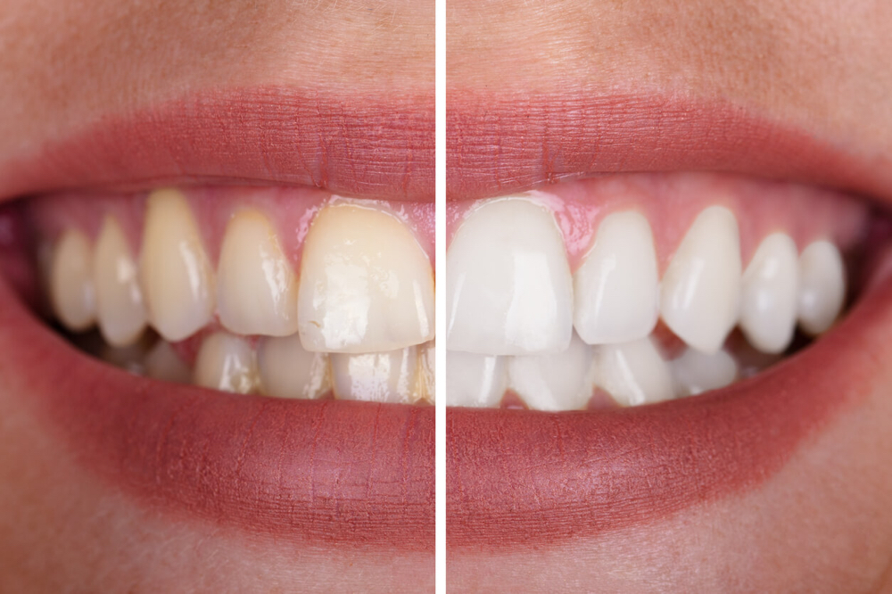 Teeth Whitening 30 Mins
