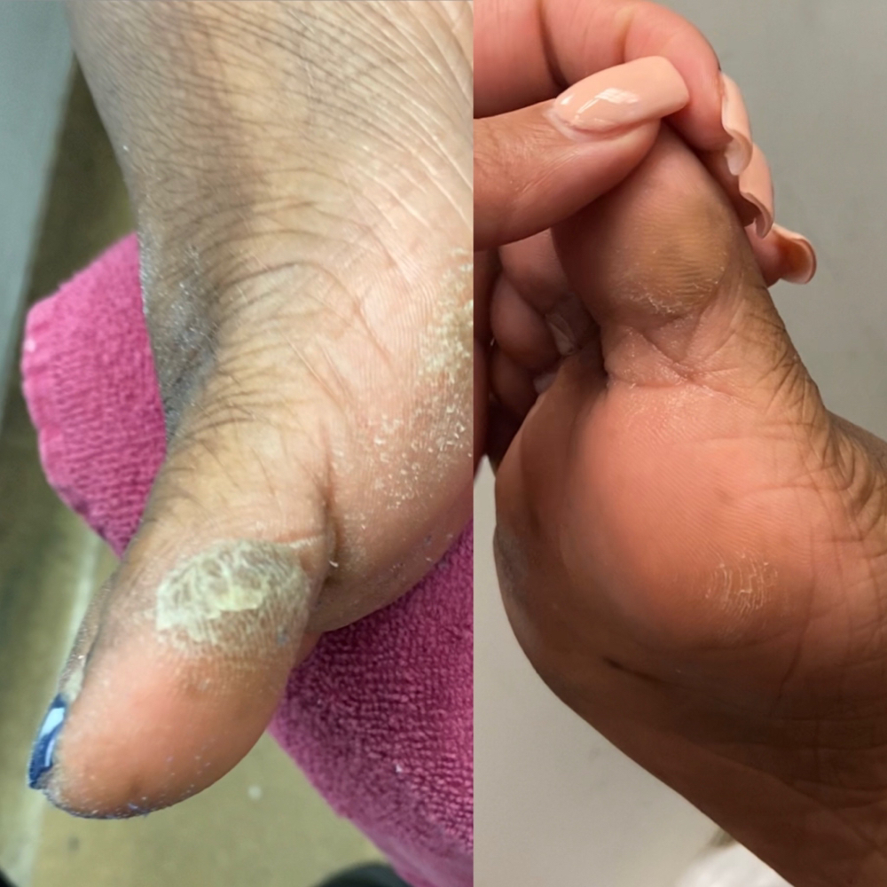 Extensive Callus Treatment (add On)