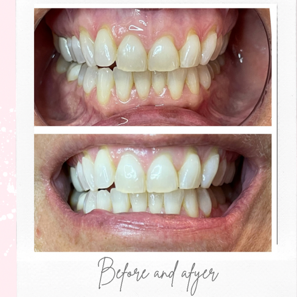 Teeth Whitening at LashBeautyBar954 in oakland park, FL