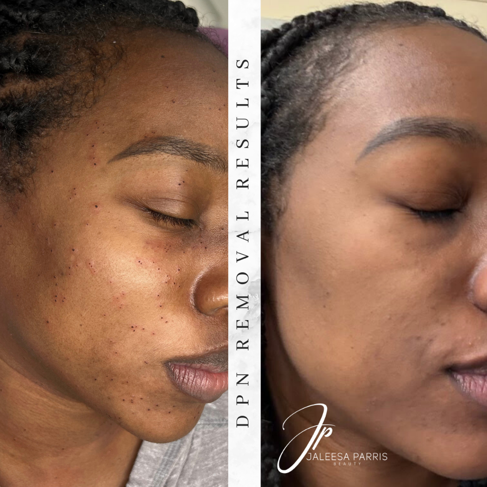 9. DPN/Skin Tag Removal