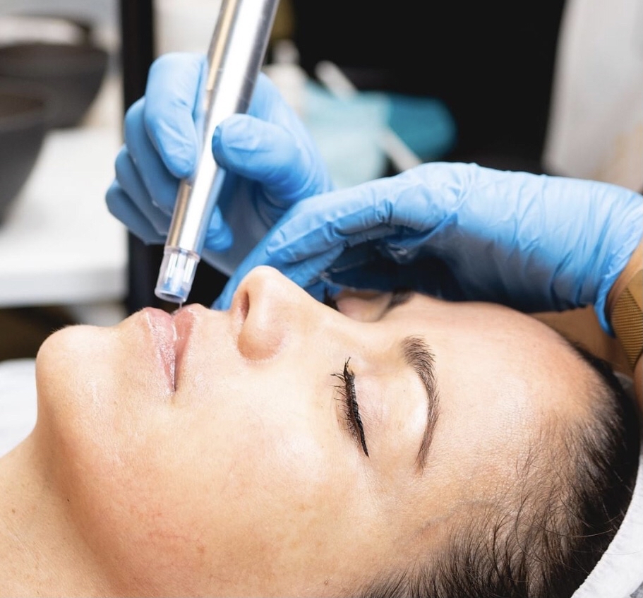 Nano-Needling With Dermaplaning