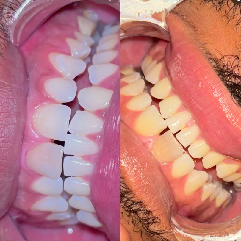 Teeth whitening: Add On Special