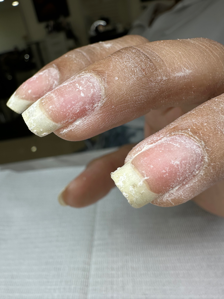 Artificial Nail Removal