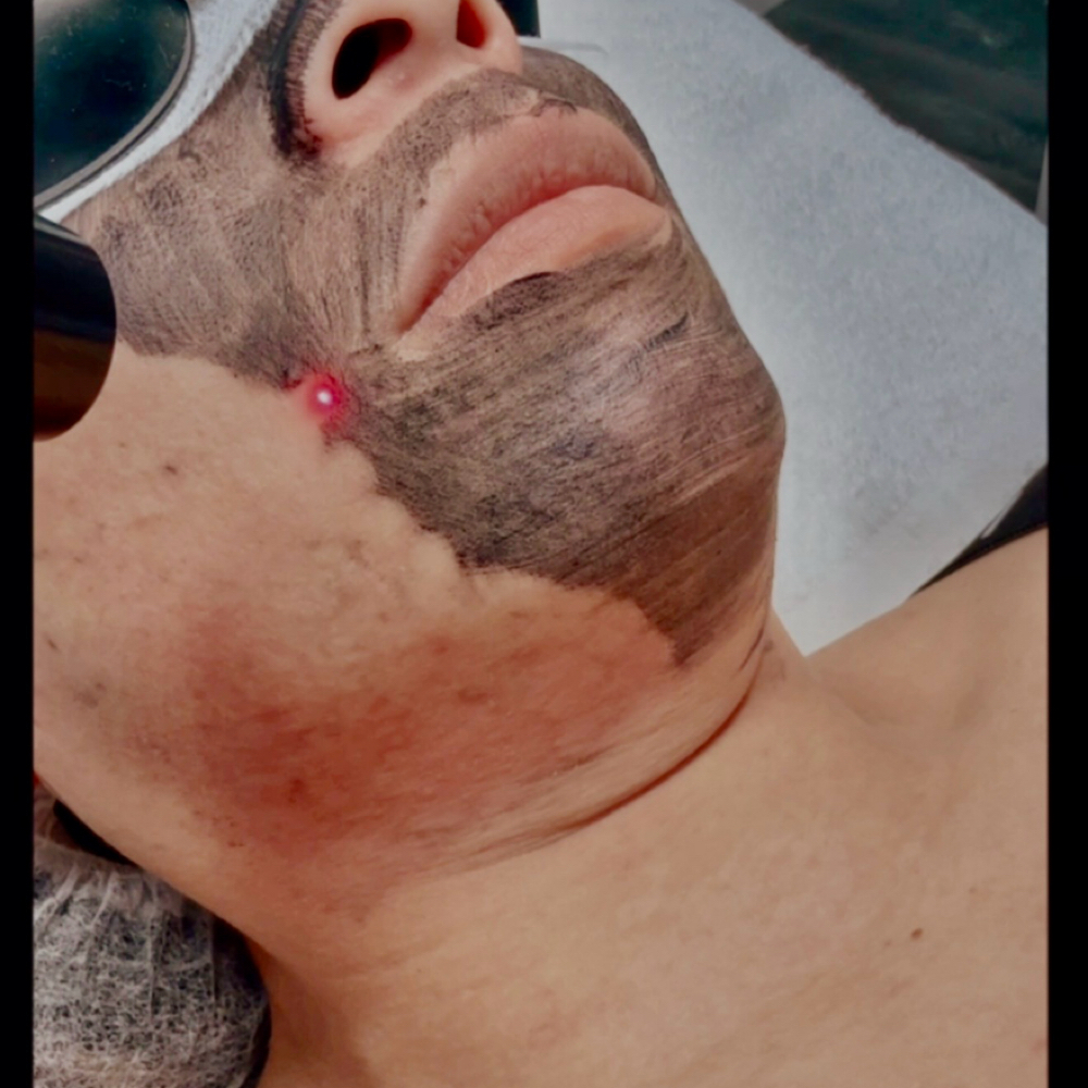 Hollywood Peel (Rostro, Cuello) + at Any Beauty Aesthetics Care in New York, NY