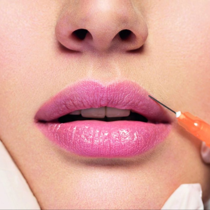 LIP FILLERS at Buena Vida Health and Wellness in Lubbock, TX
