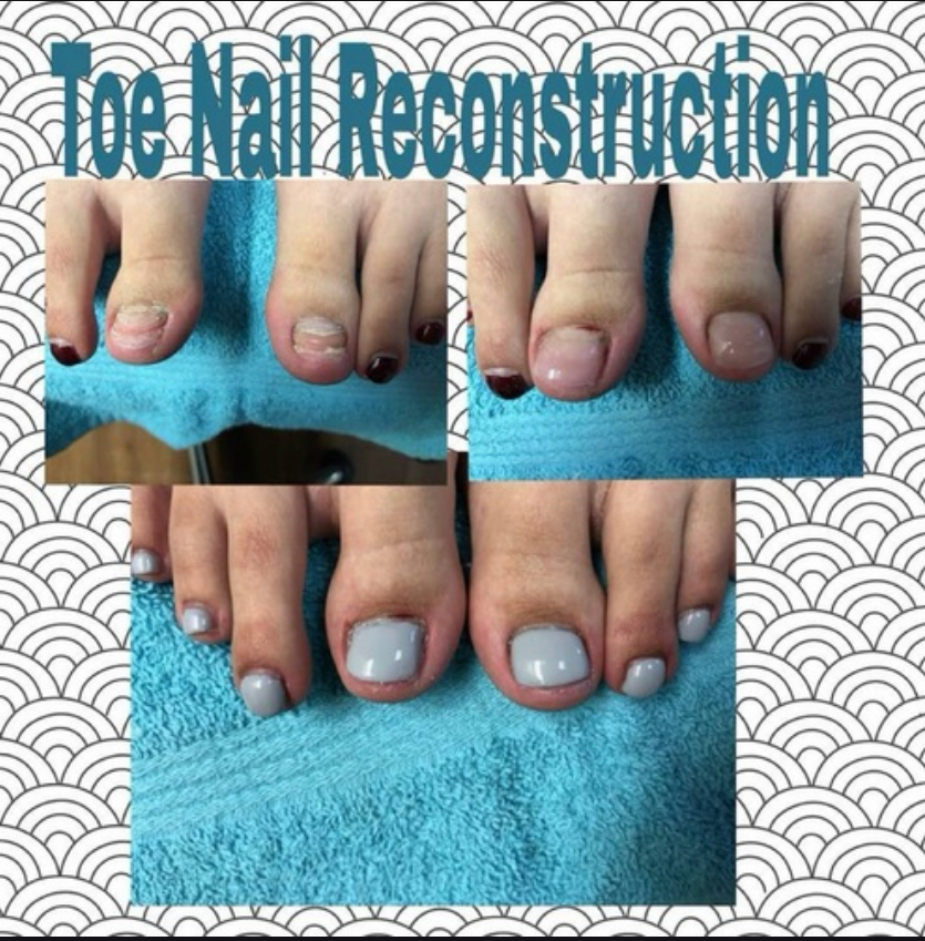 Toenail Reconstruction