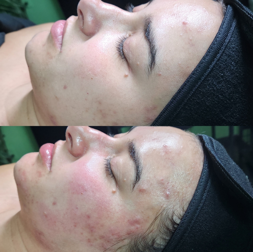 Acne Treatment Facial