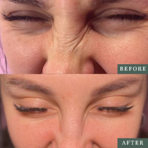 ADD ON: bunny lines or nose lift at Chelsea Injects in Kingwood, TX
