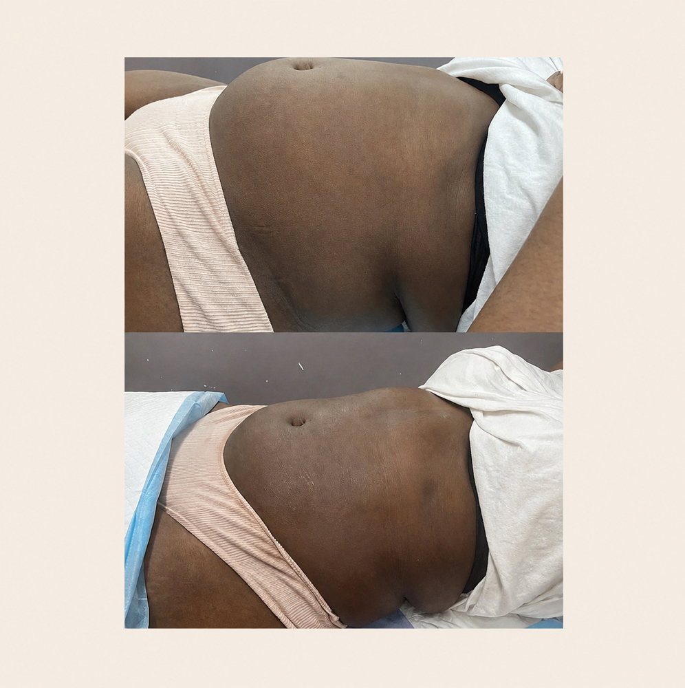 Waist Sculpt - 3 Session Package at BODIEDBYNICKEI LLC in The Bronx, NY