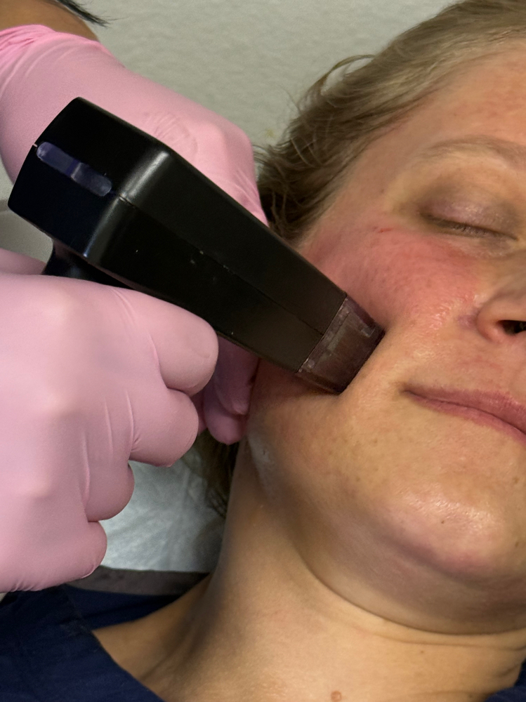 Morpheus8+PRP Facial