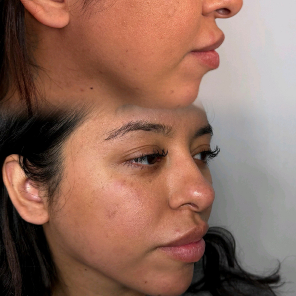 Jawline/Pre Jowl at Eluxy Aesthetics in Arlington, TX