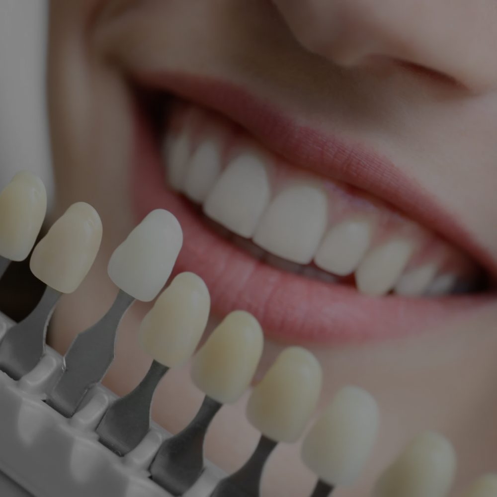30 Min (Touch Up) Whitening Session