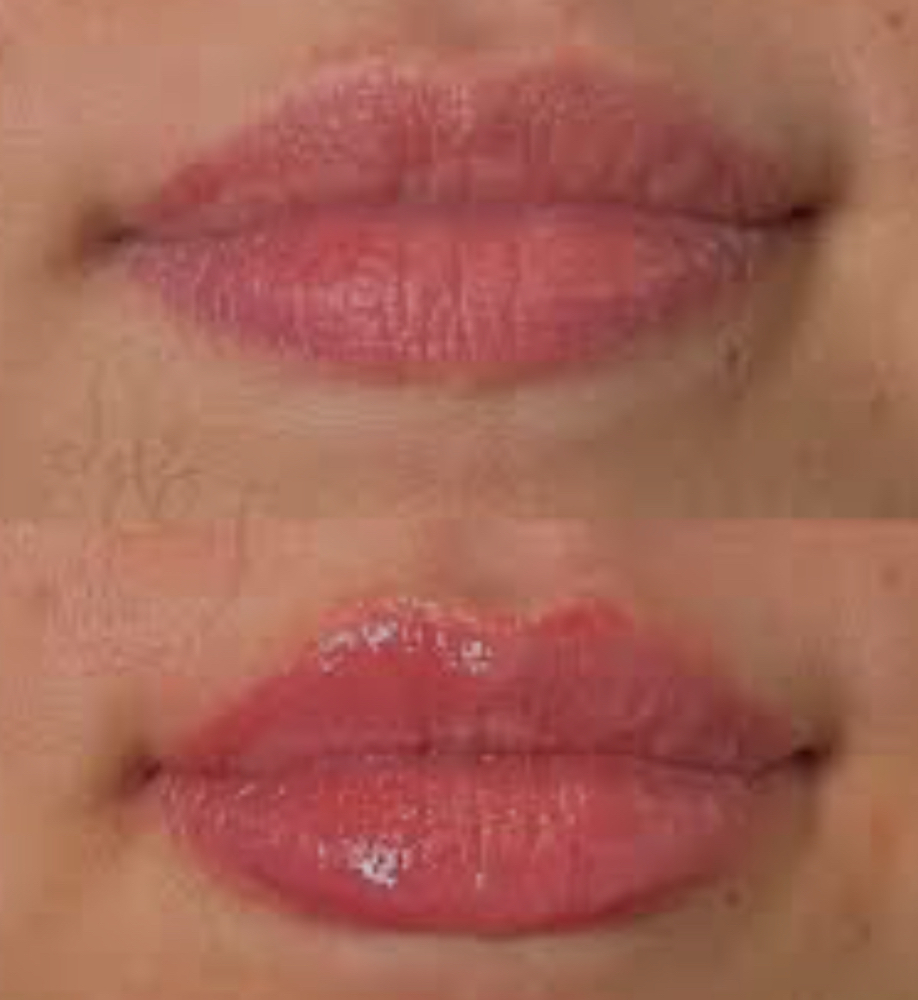 Restylane Kysse 0.5 ml