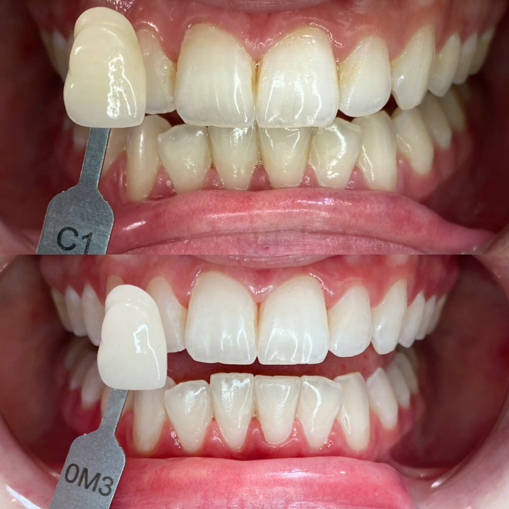 Professional Whitening Initial