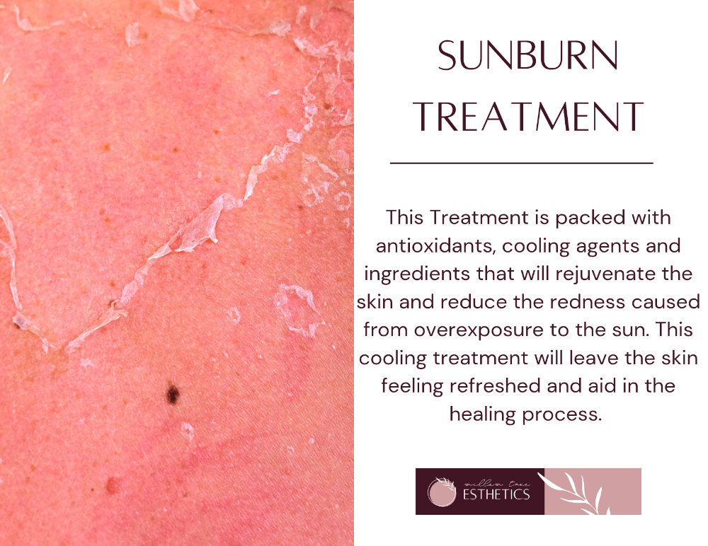 Sunburn Treatment