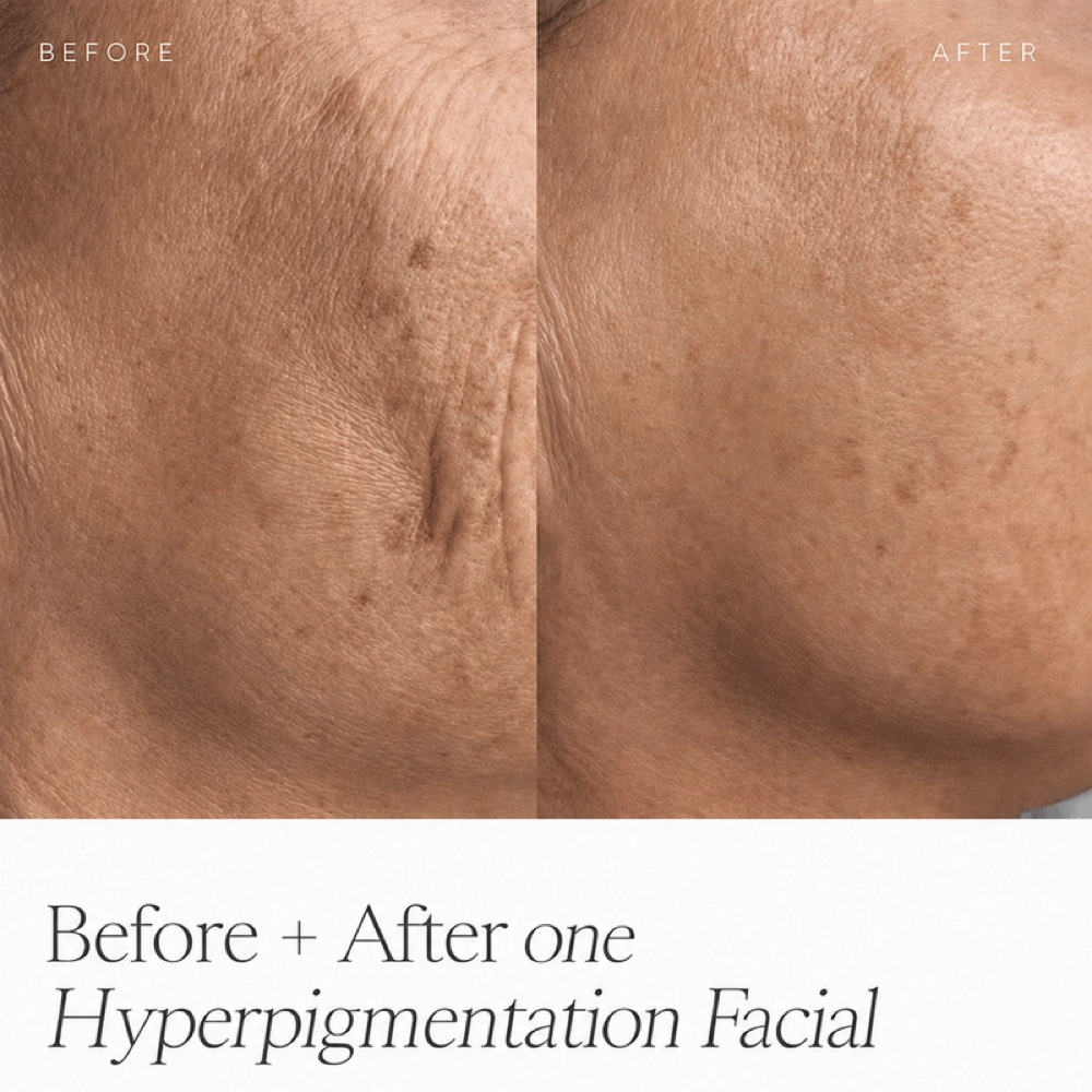 Hyperpigmentation Facial at The Ceremony Room Organic Facial & Make-up Studio in St. Augustine, FL