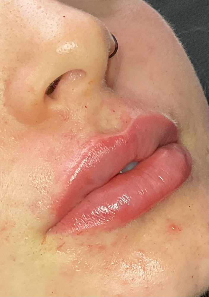 2ml Filler at Punchy Pouts & Esthetics in Amarillo, TX