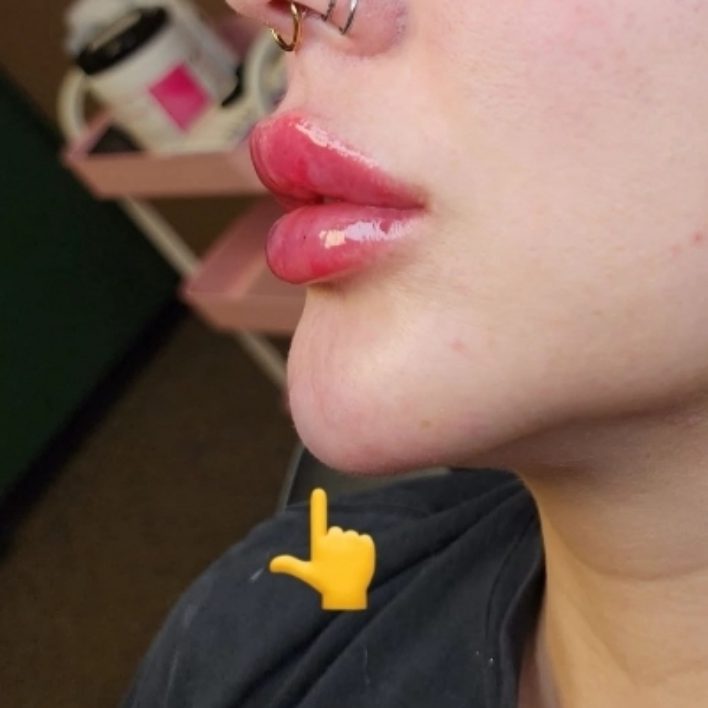 Chin Filler (Models) at Lavish Luxuries in Lubbock, TX