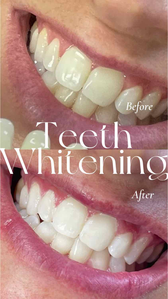 Teeth Whitening