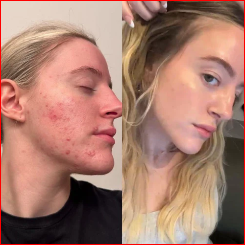 Cell Story- Liquid Microneedling Tx