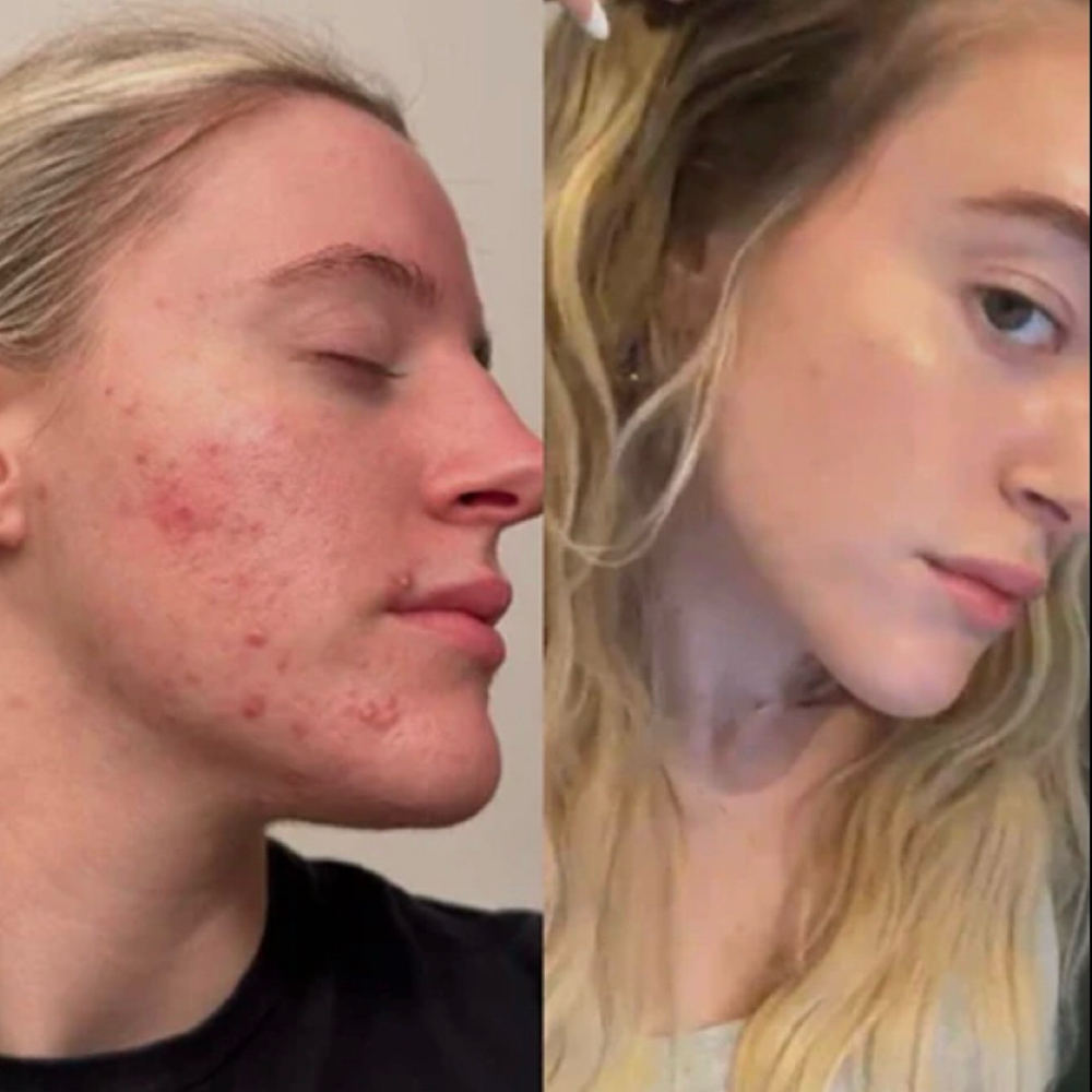 Cell Story- Liquid Microneedling Tx at Rejuva Glow Beauty in Bethesda, MD