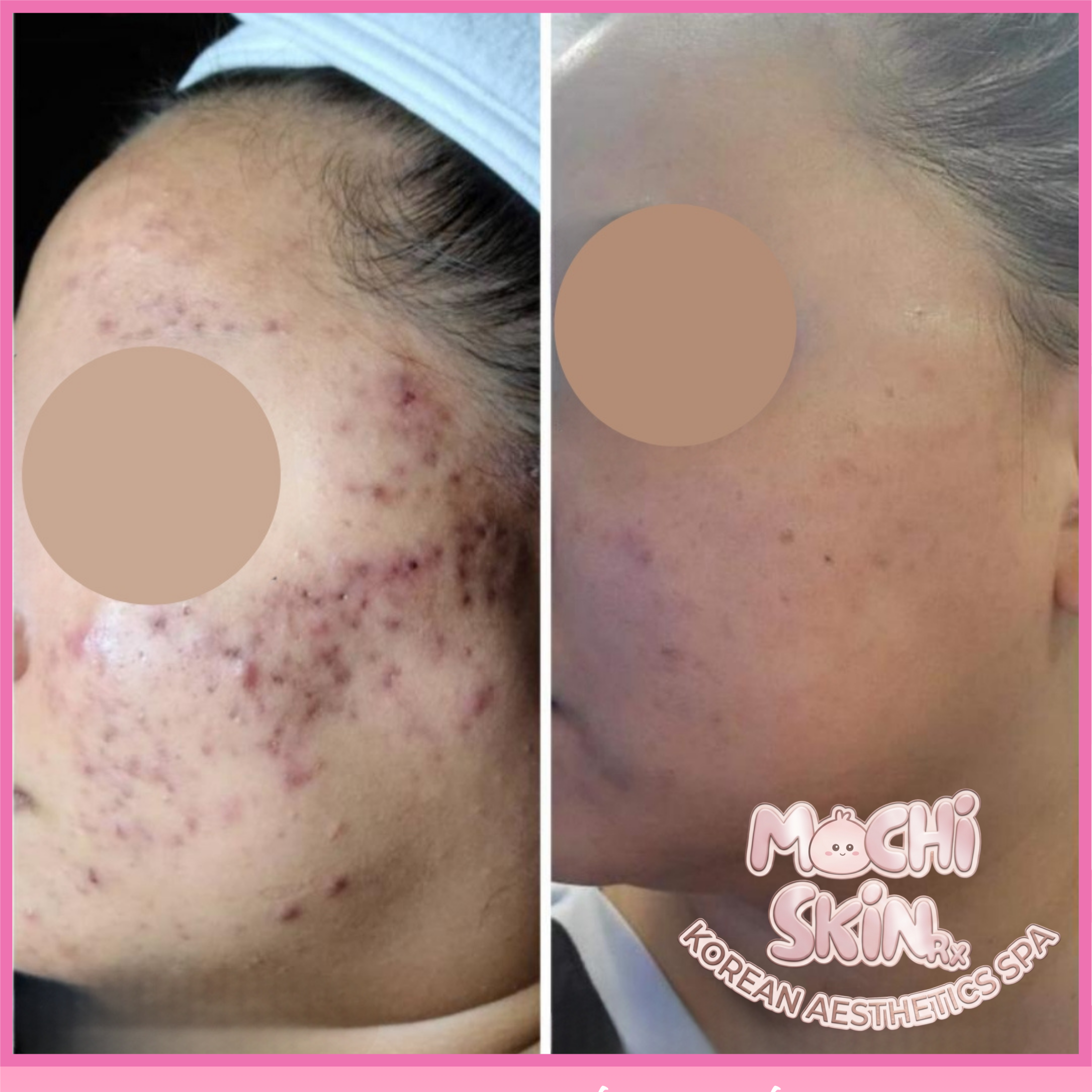 Korean Custom Peel at Mochi Skin Rx in Roseville, MN