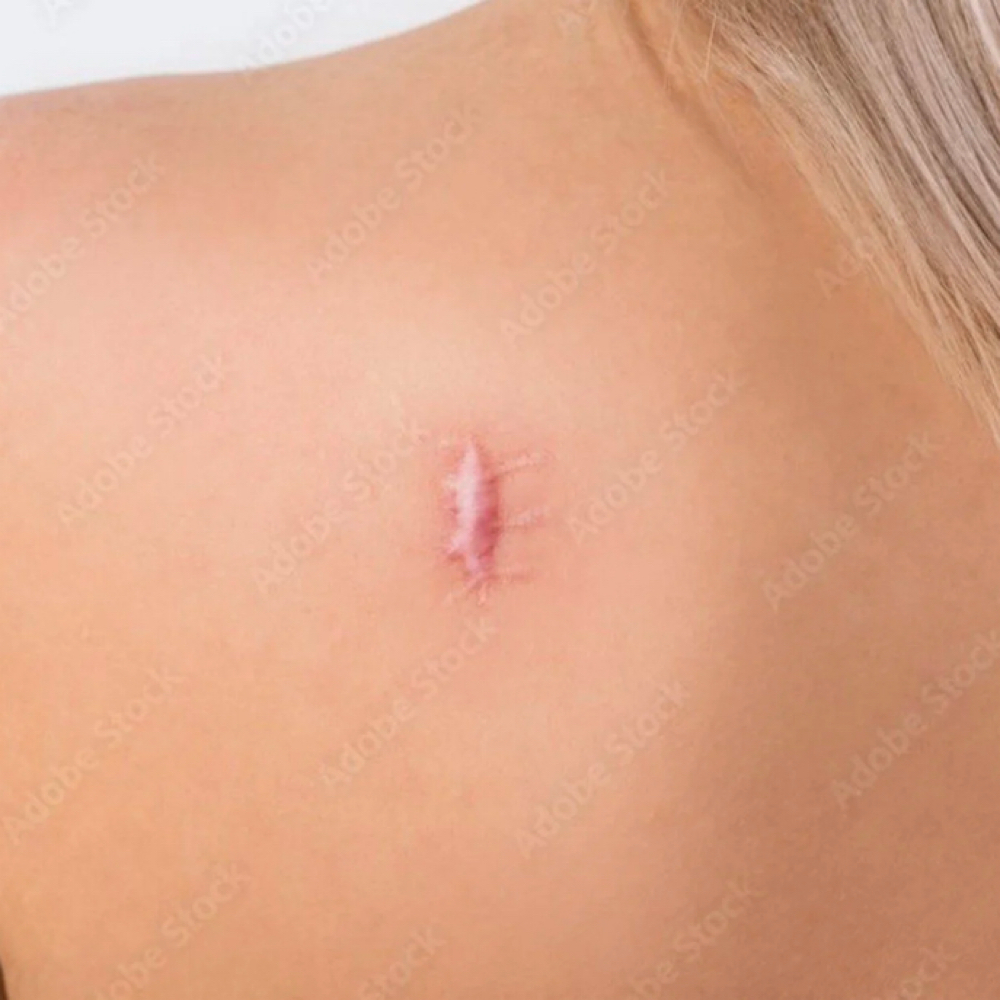 Raised Scar & Keloid Treatment at Bliss Beauty Spa in Thomaston, ME