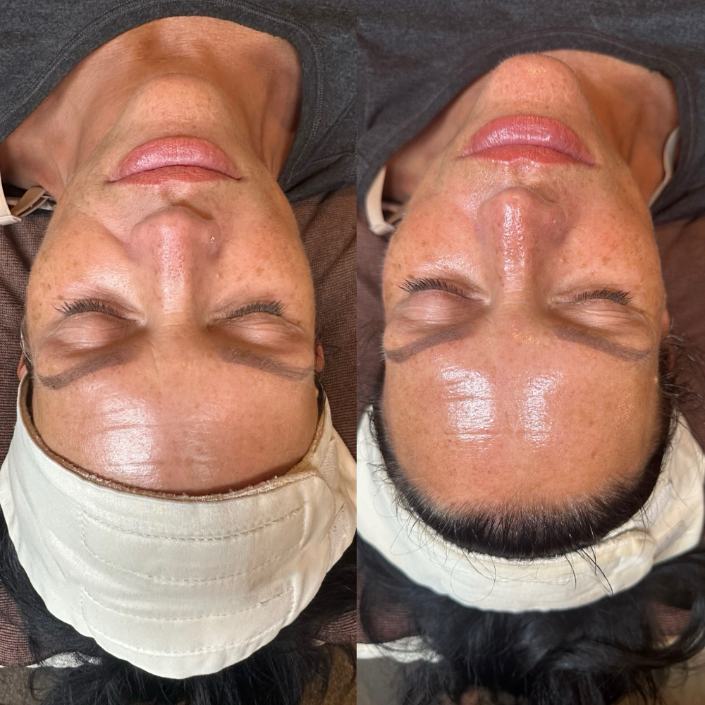 Salmon DNA Regenerating facial