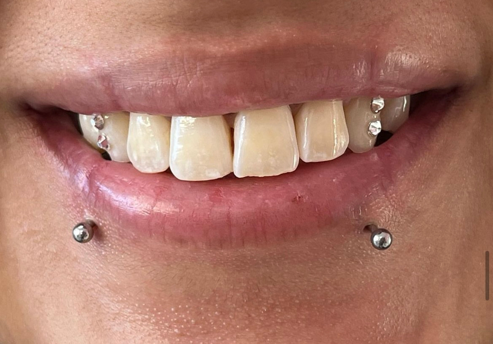 4 Tooth Gems