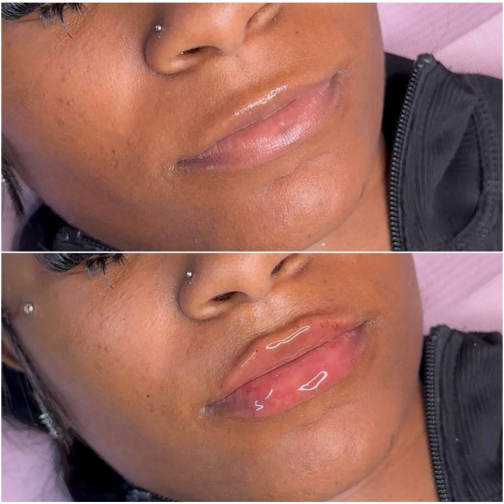 .5mL (Restylane Kiss) at Pretty By Princess in Philadelphia, PA