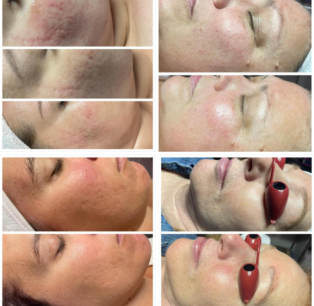 Full Facial Skin Renewal