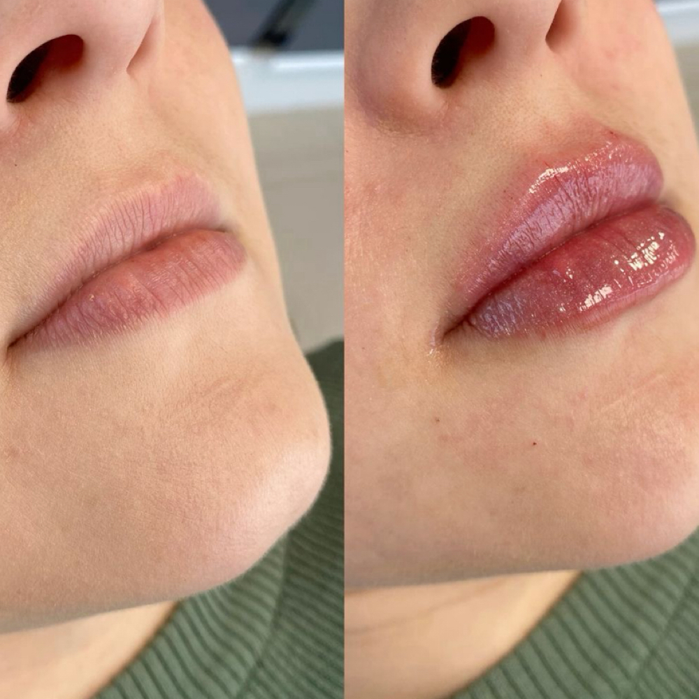 0.7 ml Lip Filler at Atlas Beauty Haven in Brownsville, TX