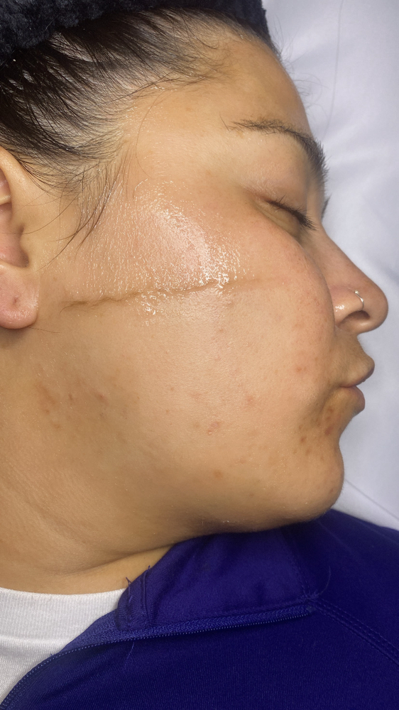 Dermaplane facial