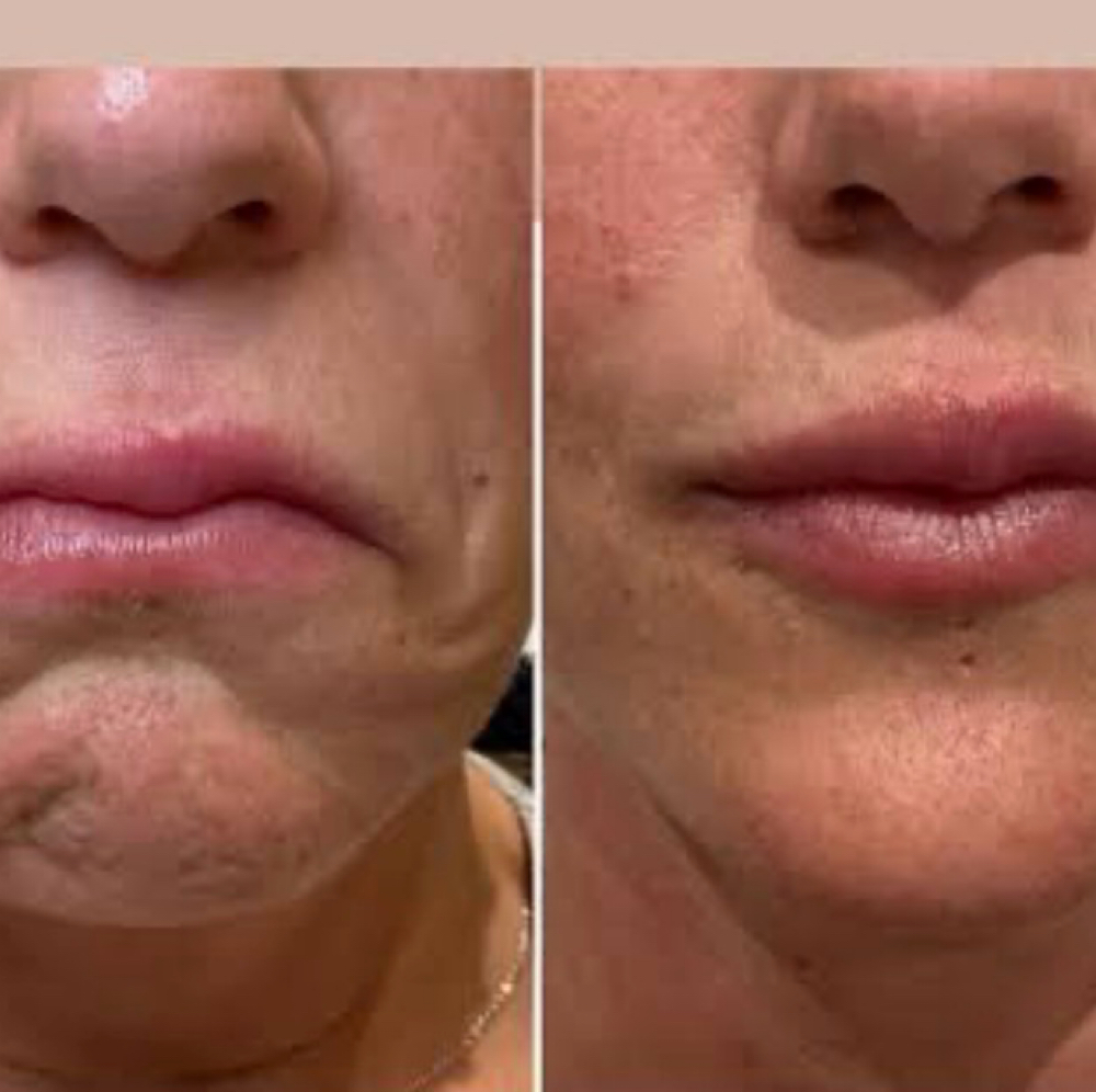 Mentalis( Chin Eraser Treatment) at Bliss Beauty Bar in Houston, TX
