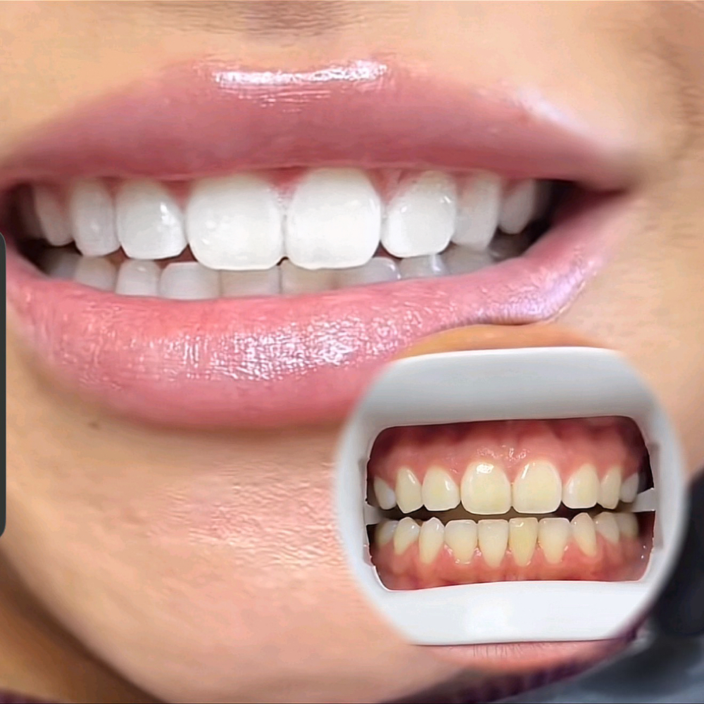 Teeth Whitening at Self Love Aesthetics in Corning, CA