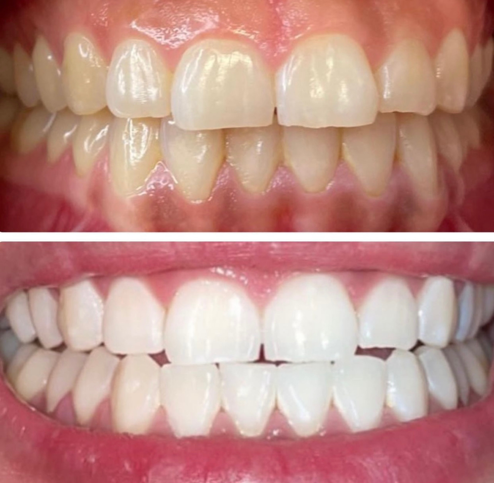 Teeth Whitening