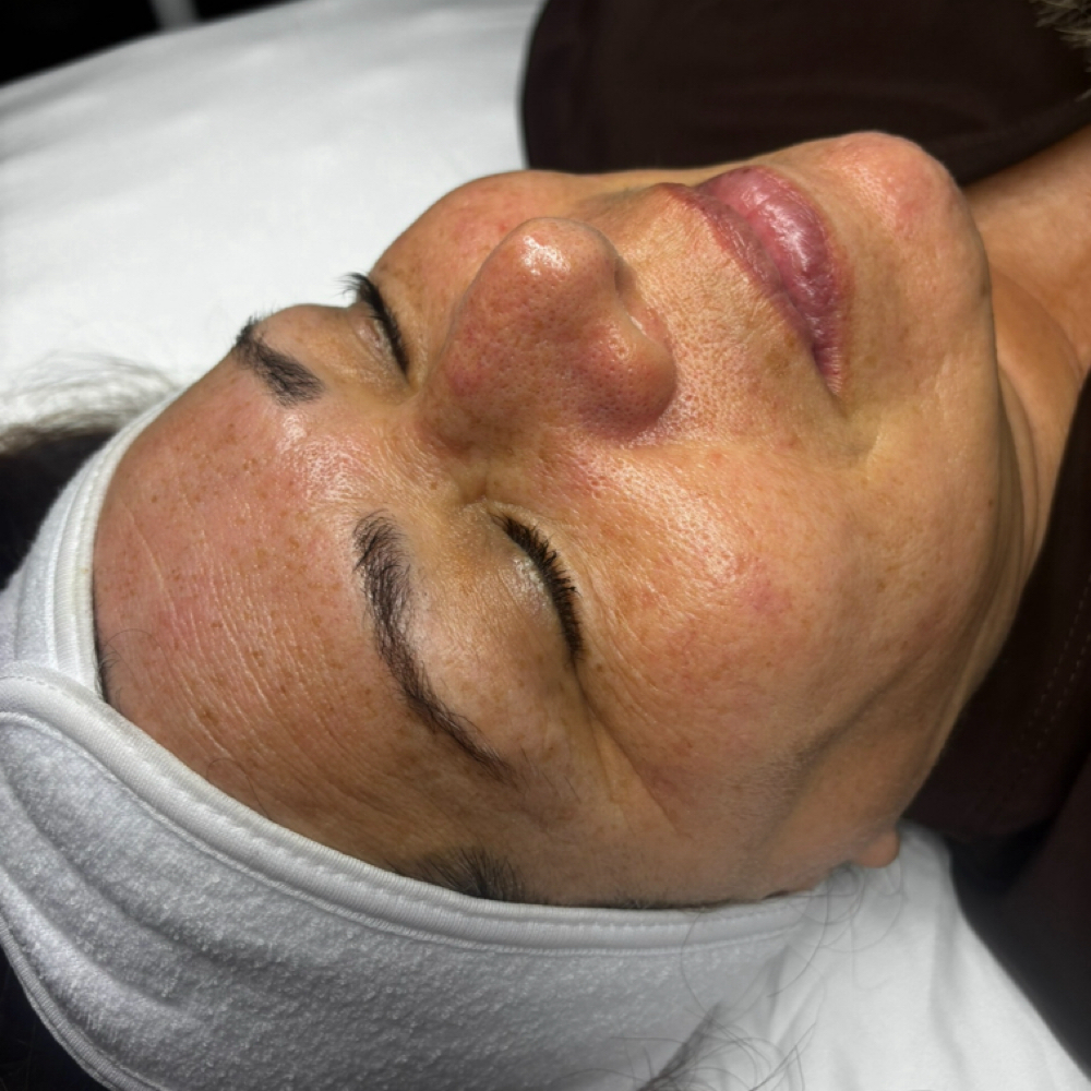 Mother of Pearl Facial at Pearly Derm in Sun valley, CA