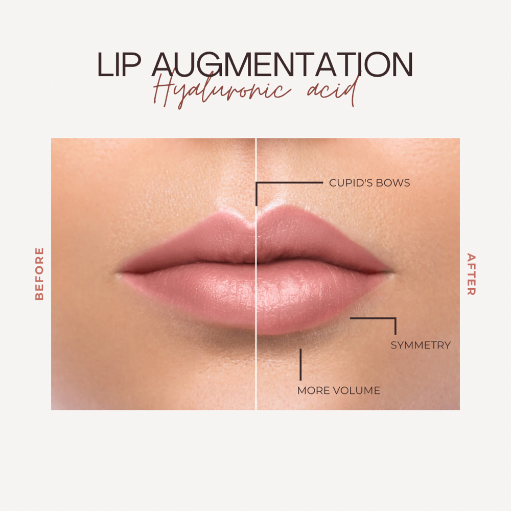Lip filler
