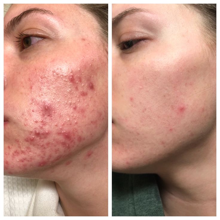 Facial Con Tratamiento De Acne