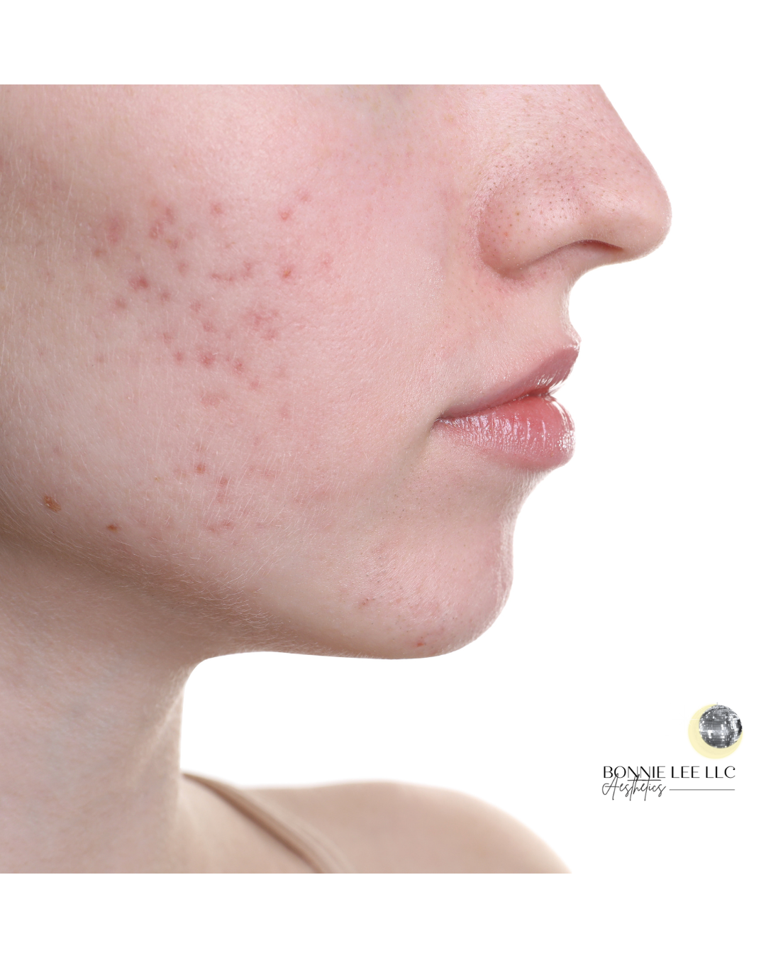 Clarifying Acne Facial